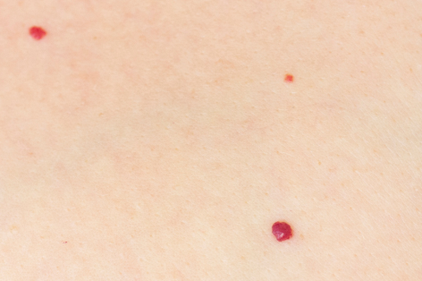 Cherry Angioma or Campbell De Morgan removal