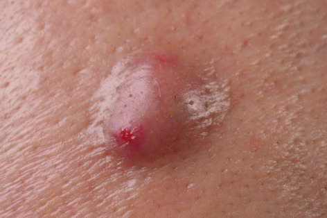 Cyst removal at the Crystal Palace Clinic