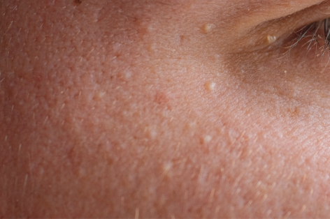 Milia removal treatment at Crystal Palace Clinic