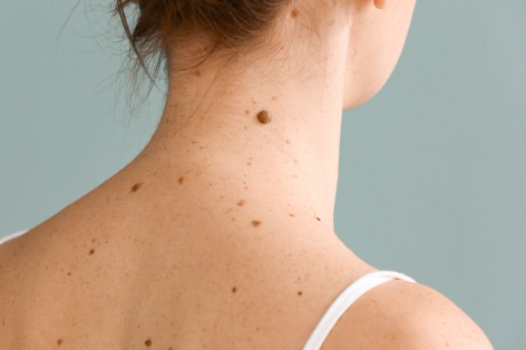 Book a mole removal appointment at Crystal Palace Clinic