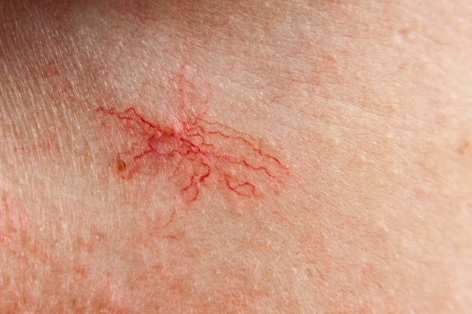 Spider Naevi removal at Crystal Palace Clinic
