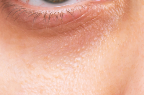 Syringoma removal at Crystal Palace Clinic