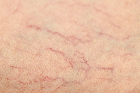 Thread vein removal at Crystal Palace Clinic