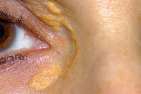 Xanthelasma removal at the Crystal Palace Clinic